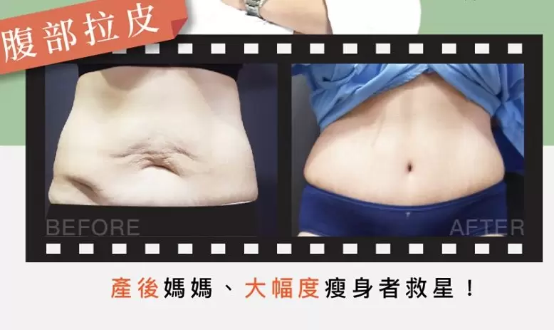腹部拉皮