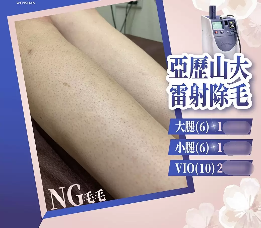 【媽媽的美學百寶箱】亞歷山大雷射除毛