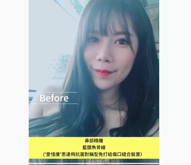高雄微整形【鼻部精雕】