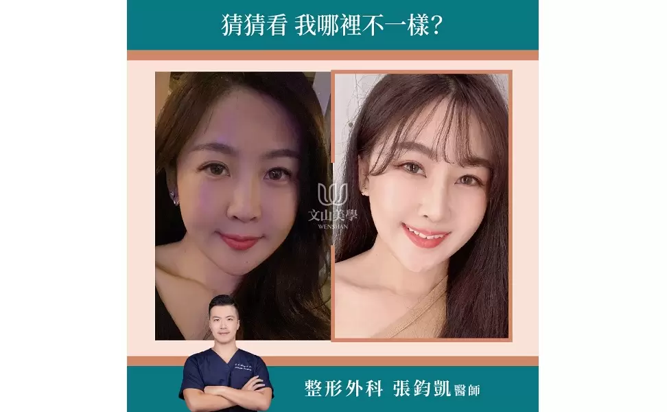 哪裡不一樣？大家來找找~高雄整形外科張鈞凱醫師專業客製化量身打造