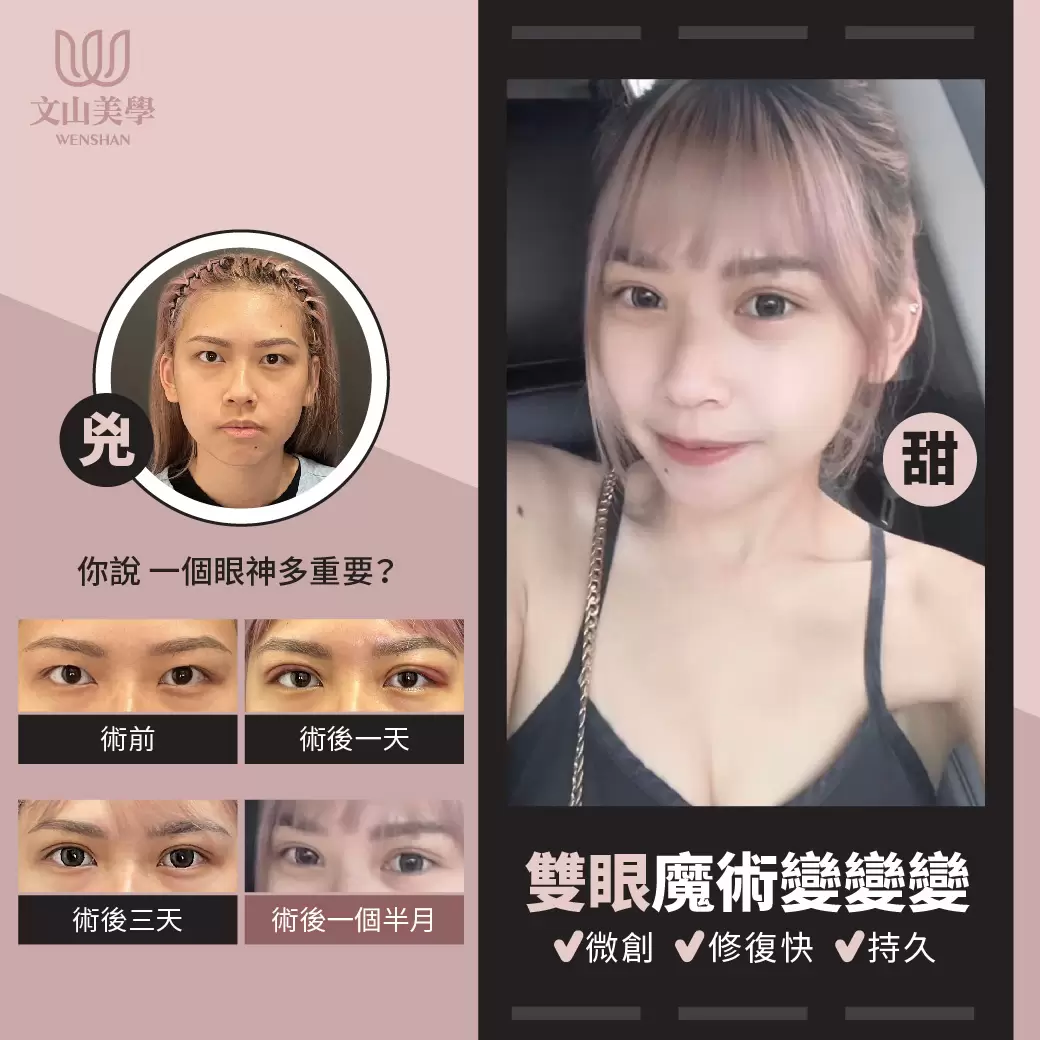高雄整形外科張鈞凱醫師 眼神有多重要～你看～兇兇的變甜甜的
