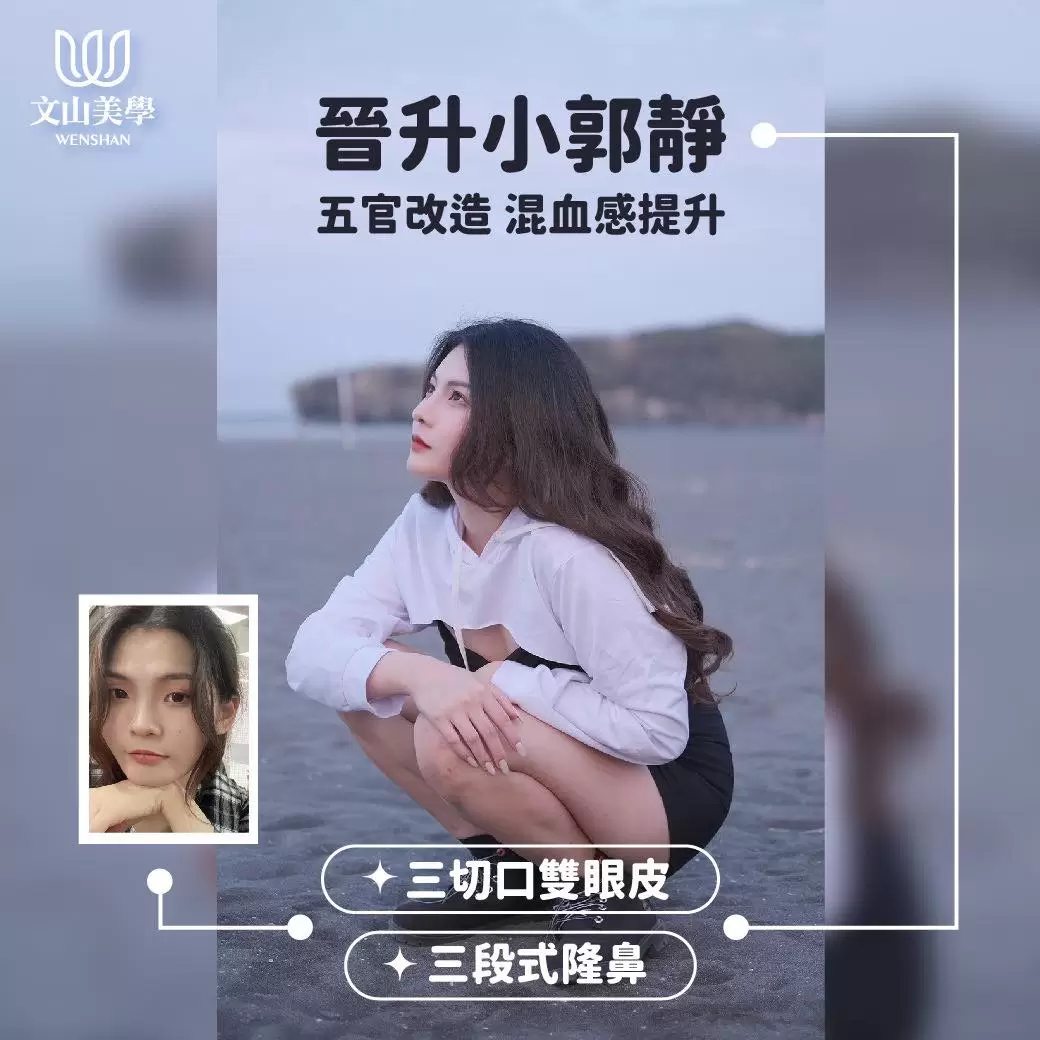 五官改造 混血感提升 高雄整形外科張鈞凱醫師 三切口雙眼皮 三段式隆鼻