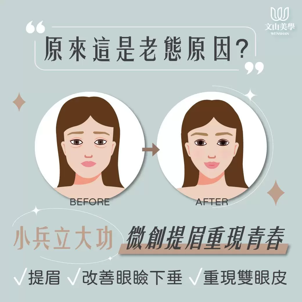 想改善眼瞼下垂 重現雙眼皮 高雄整形外科張鈞凱醫師 微創提眉對抗眼周老化超有感！