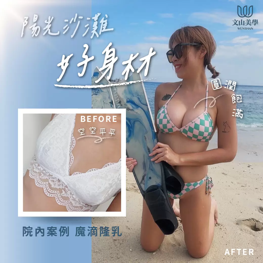 今年夏天我圓夢了 高雄整形外科張鈞凱醫師 魔滴隆乳院內案例