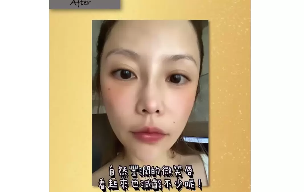 院內案例玻尿酸豐唇 性感減齡嘟嘟微笑唇讓人忍不住想多親幾下