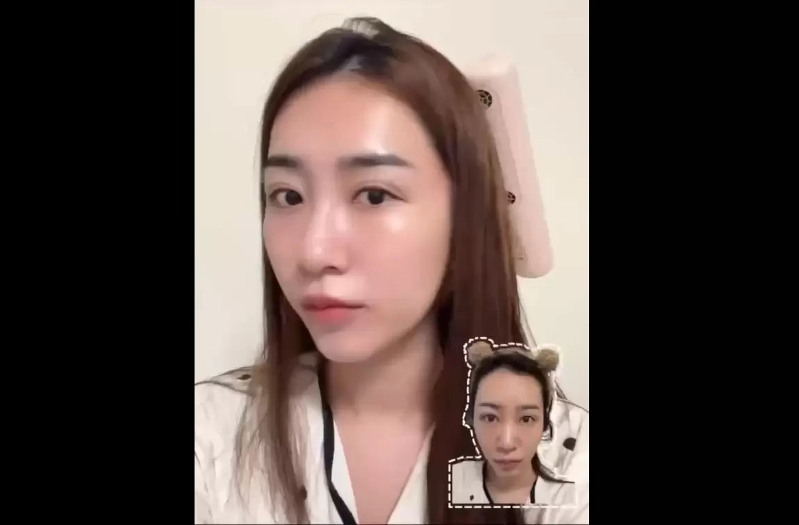對光敏感或不愛雷射但又嚮往韓妞的光澤肌？水光注射是絕佳選擇
