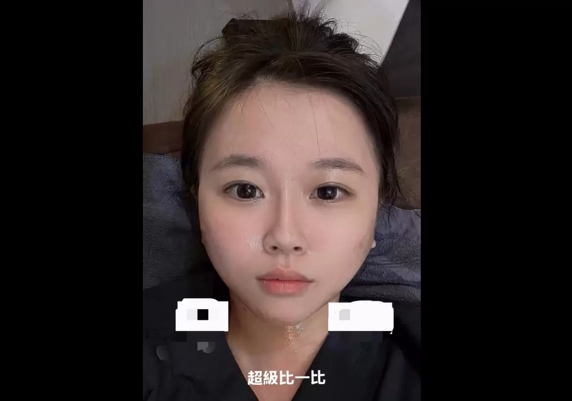 昂達超微波ONDA讓鬆垮肉鬆臉乾淨俐落的輪廓線條貼骨浮現